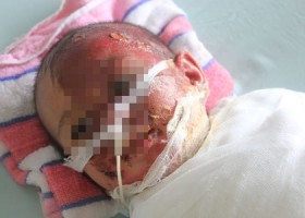 Bé 20 tháng bị bỏng nguy kịch vì vật dụng nhà nào cũng có